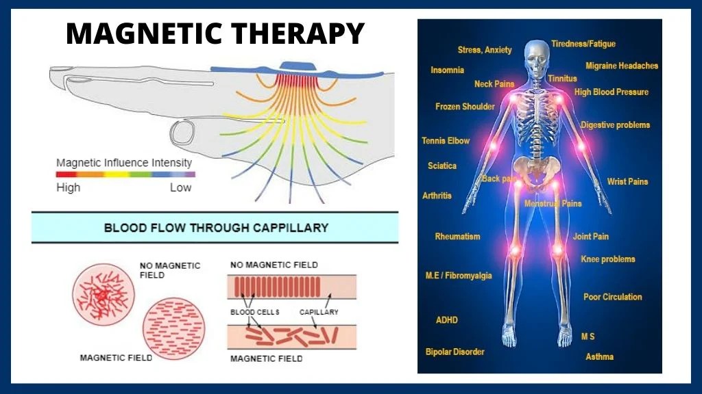 magnet therapy